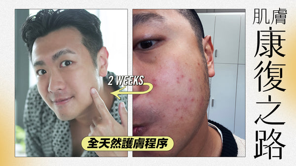 【擊退紅腫粒粒!】我的過敏康復之路 (消炎篇)| 護膚品店老闆教你 2 星期極速復元 (附詳細產品程序)